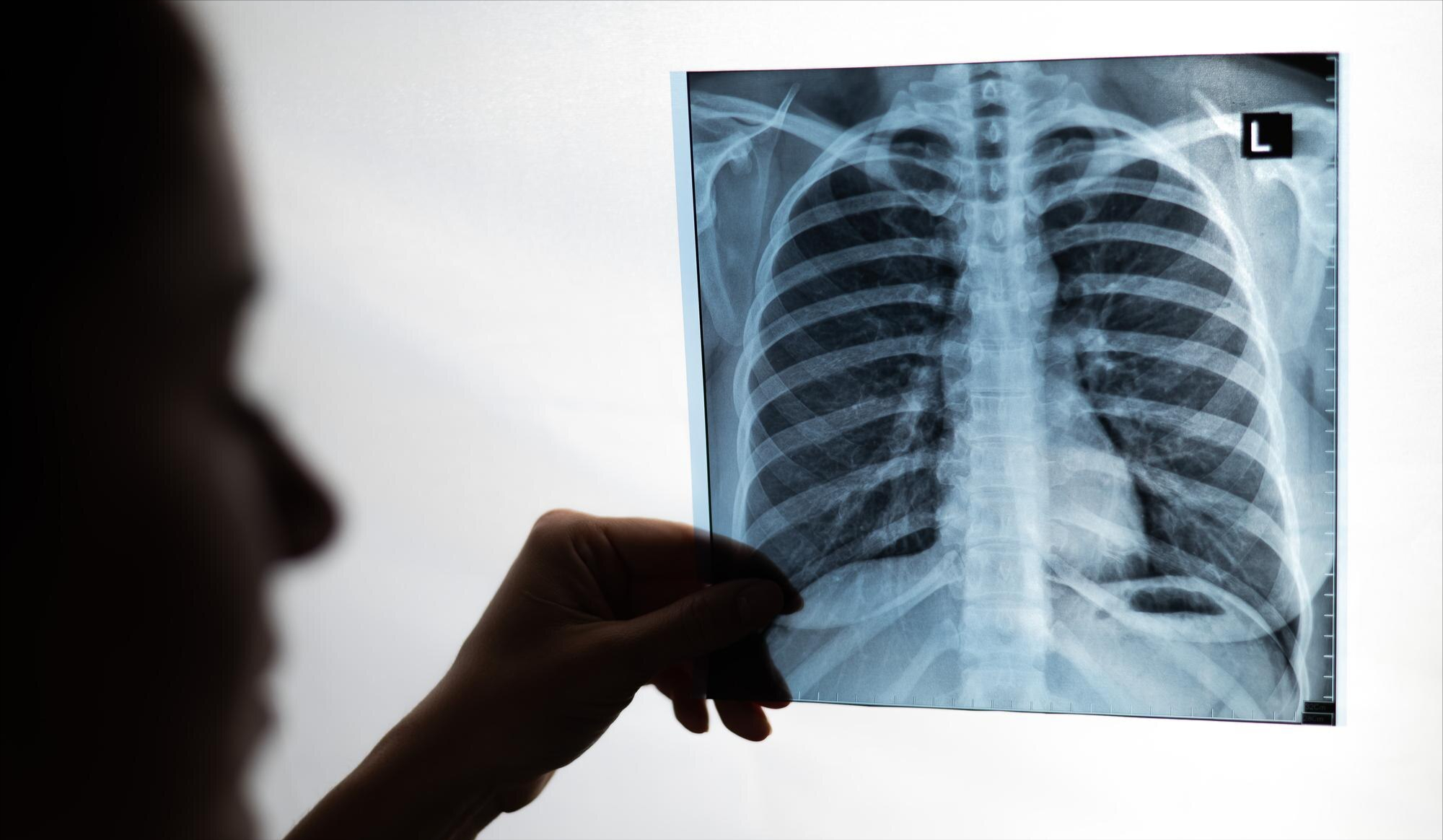 À quel âge vos poumons commencent-ils à perdre de leur capacité ?