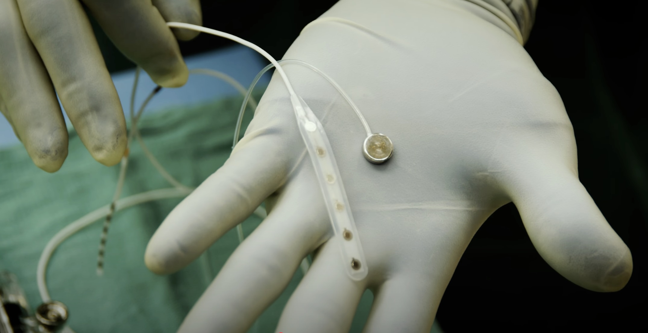 Un patient reçoit un implant cérébral capable de contrôler des ordinateurs sans fil
