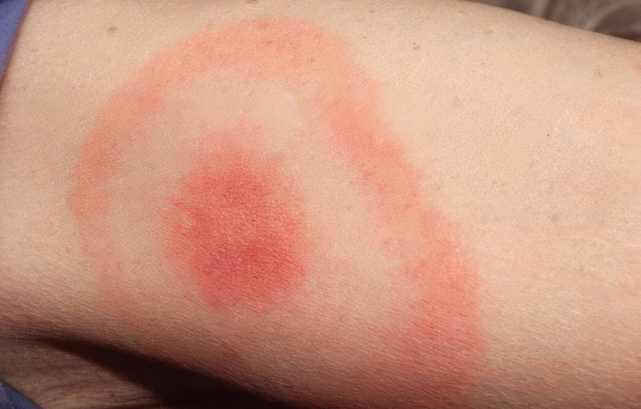 Le premier signe à ne pas ignorer : la fameuse éruption cutanée