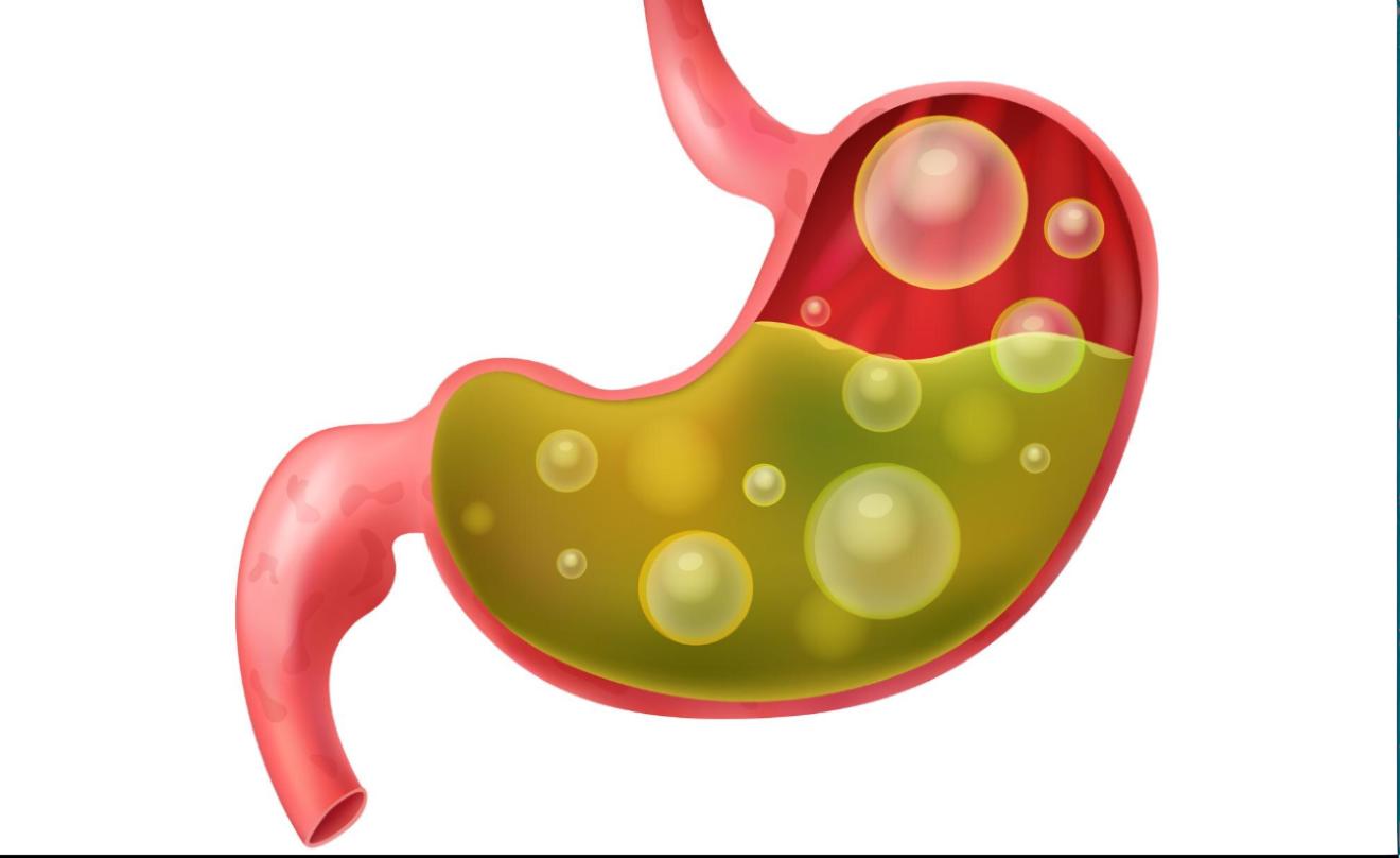 6. Les remontées acides de l'estomac (RGO)