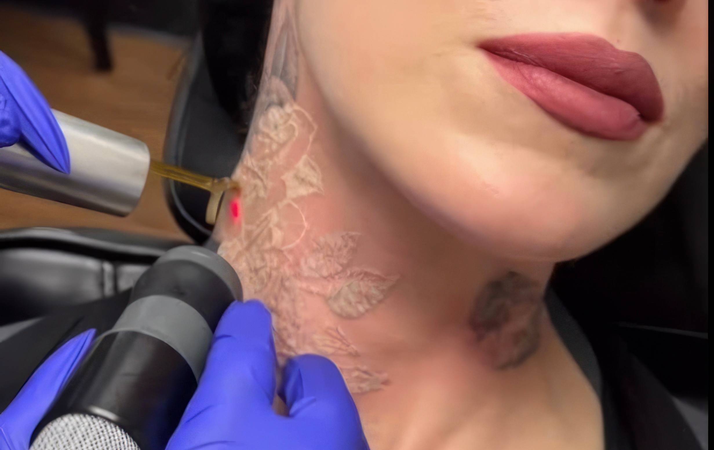 Nouvelle étape : effacer les tatouages au laser