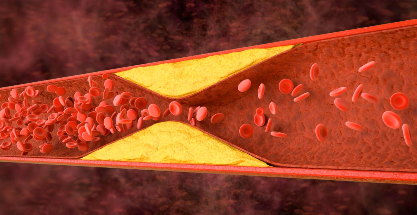 Artères bouchées : 10 signes discrets à prendre au sérieux