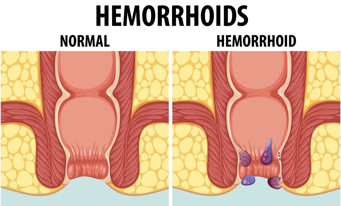 Le problème : un risque accru d'hémorroïdes
