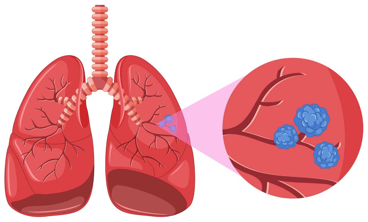 Pourquoi est-ce si inquiétant ? Le lien avec le cancer du poumon