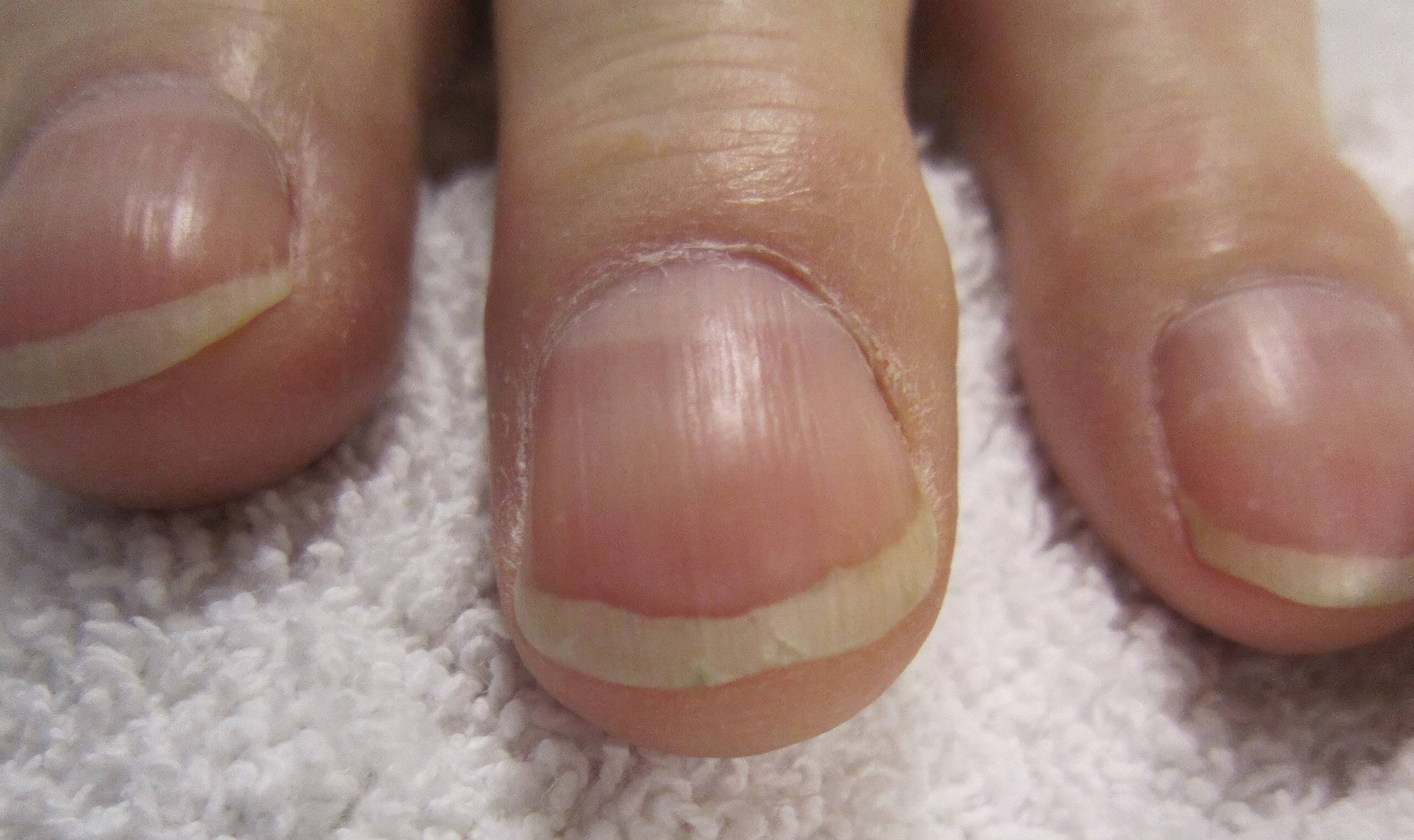 Un signe aux bouts des doigts pourrait révéler une maladie mortelle