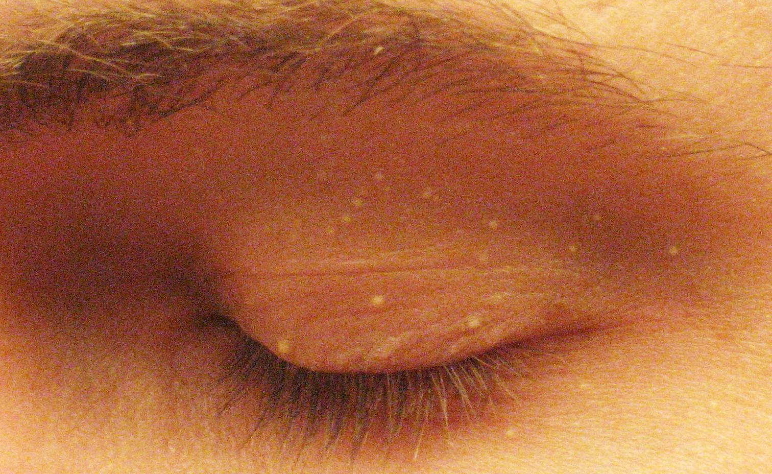 Le mystère de ces petits points blancs qui apparaissent sur votre corps (et même vos parties intimes)