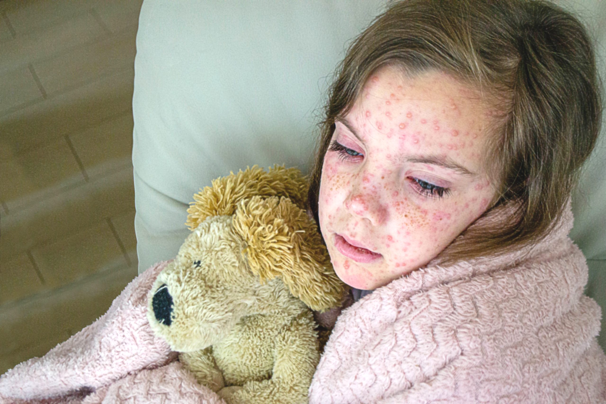 Le Canada va bientôt perdre son statut « pays sans rougeole » les États-Unis seront les prochains