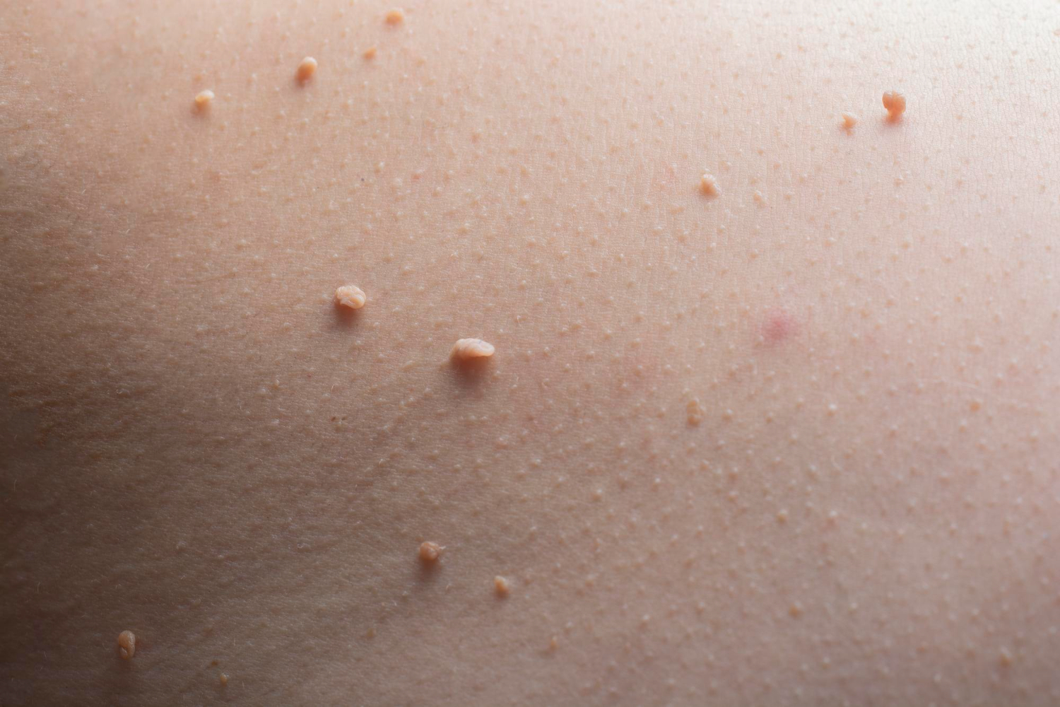 4. L'apparition d'excroissances de peau (skin tags)