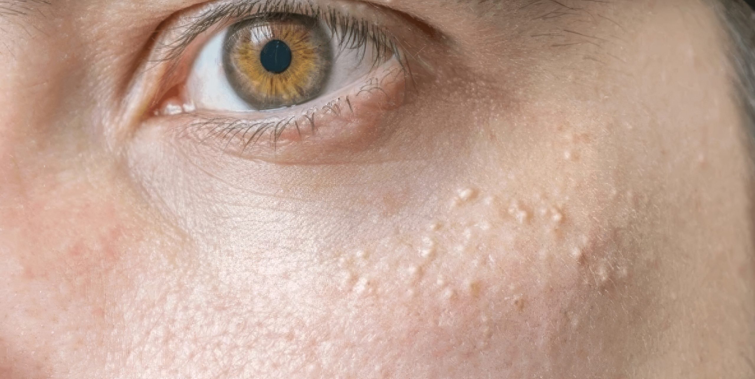 Le mystère de ces petits points blancs qui apparaissent sur votre corps (et même vos parties intimes)