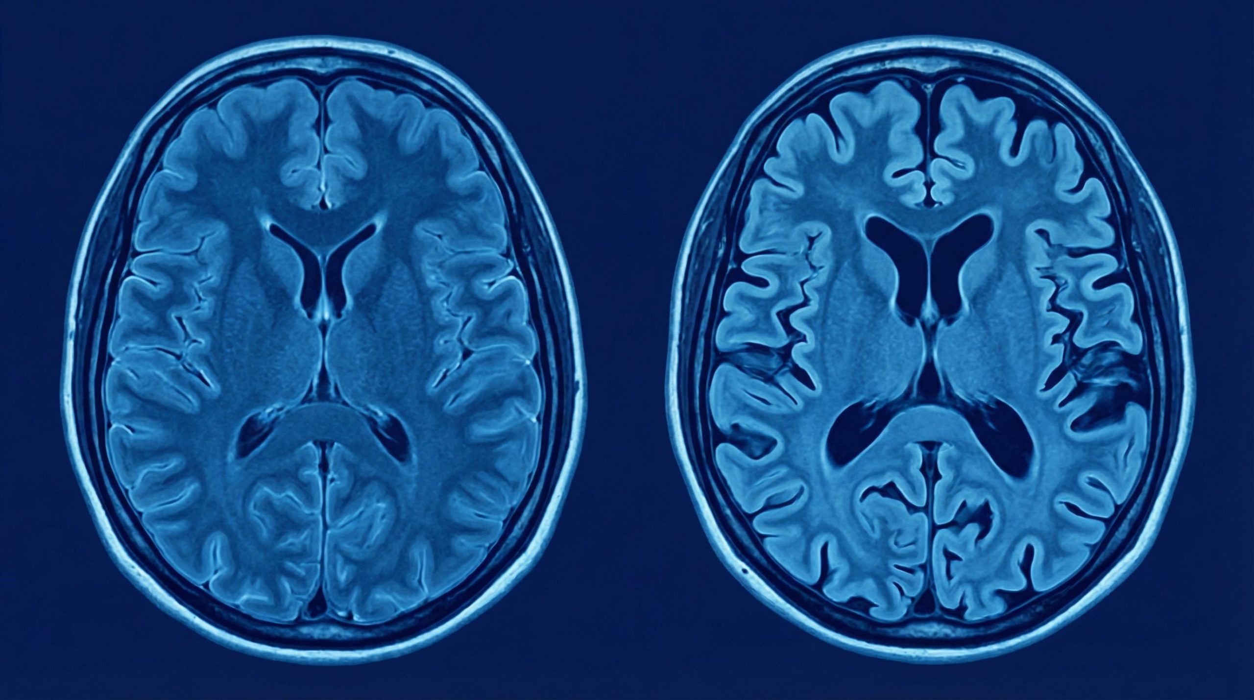 Un espoir contre l'oubli : ce médicament expérimental pourrait stopper Alzheimer avant même les premiers signes
