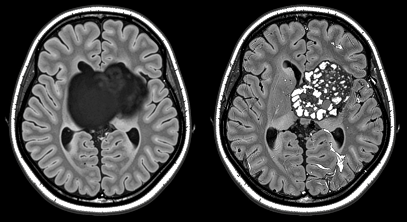 Ce cancer du cerveau mortel est aujourd’hui incurable. Des scientifiques viennent de trouver un moyen de le détruire.