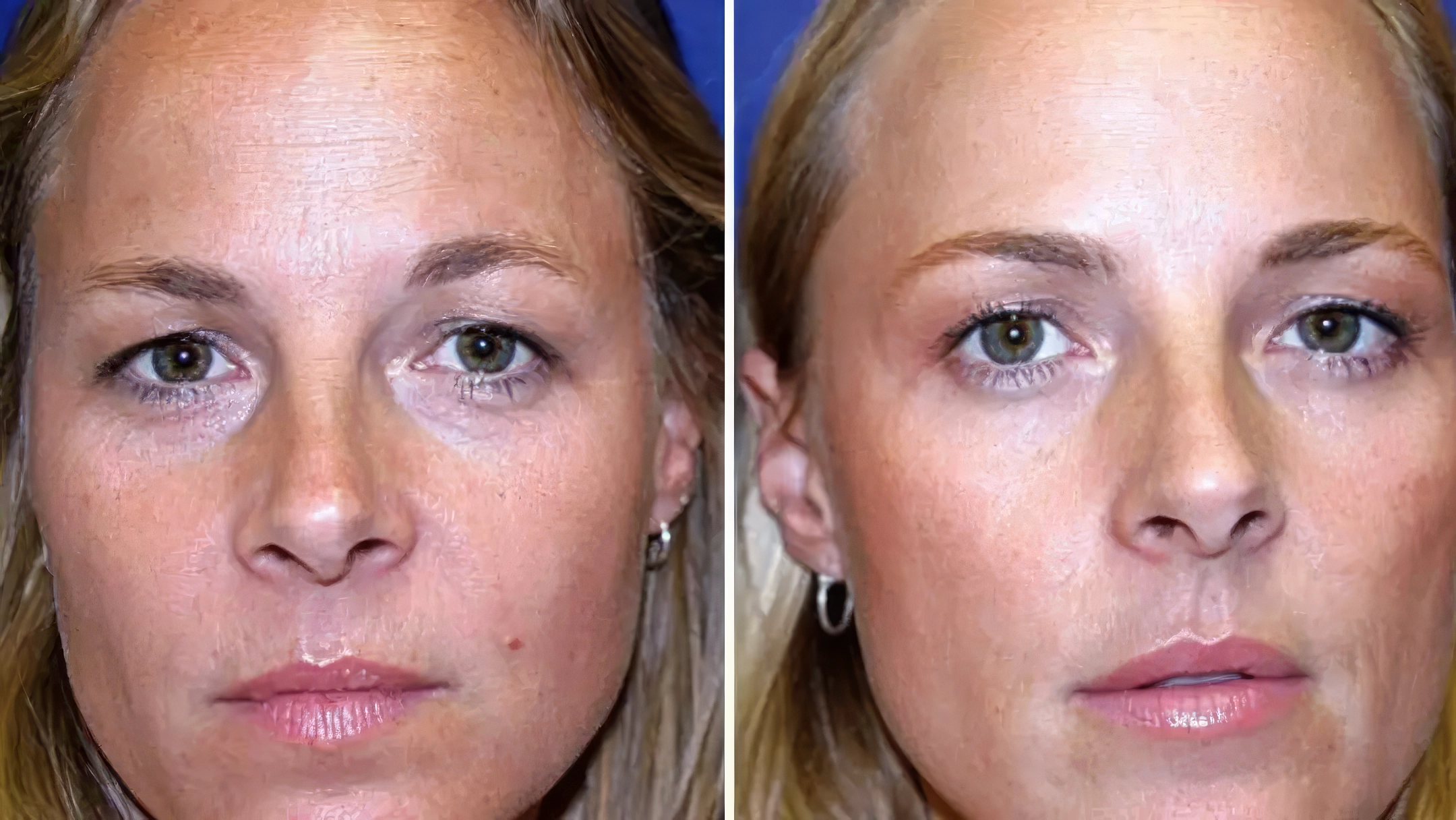 Jumeaux identiques : les effets du Botox après 13 ans comparés