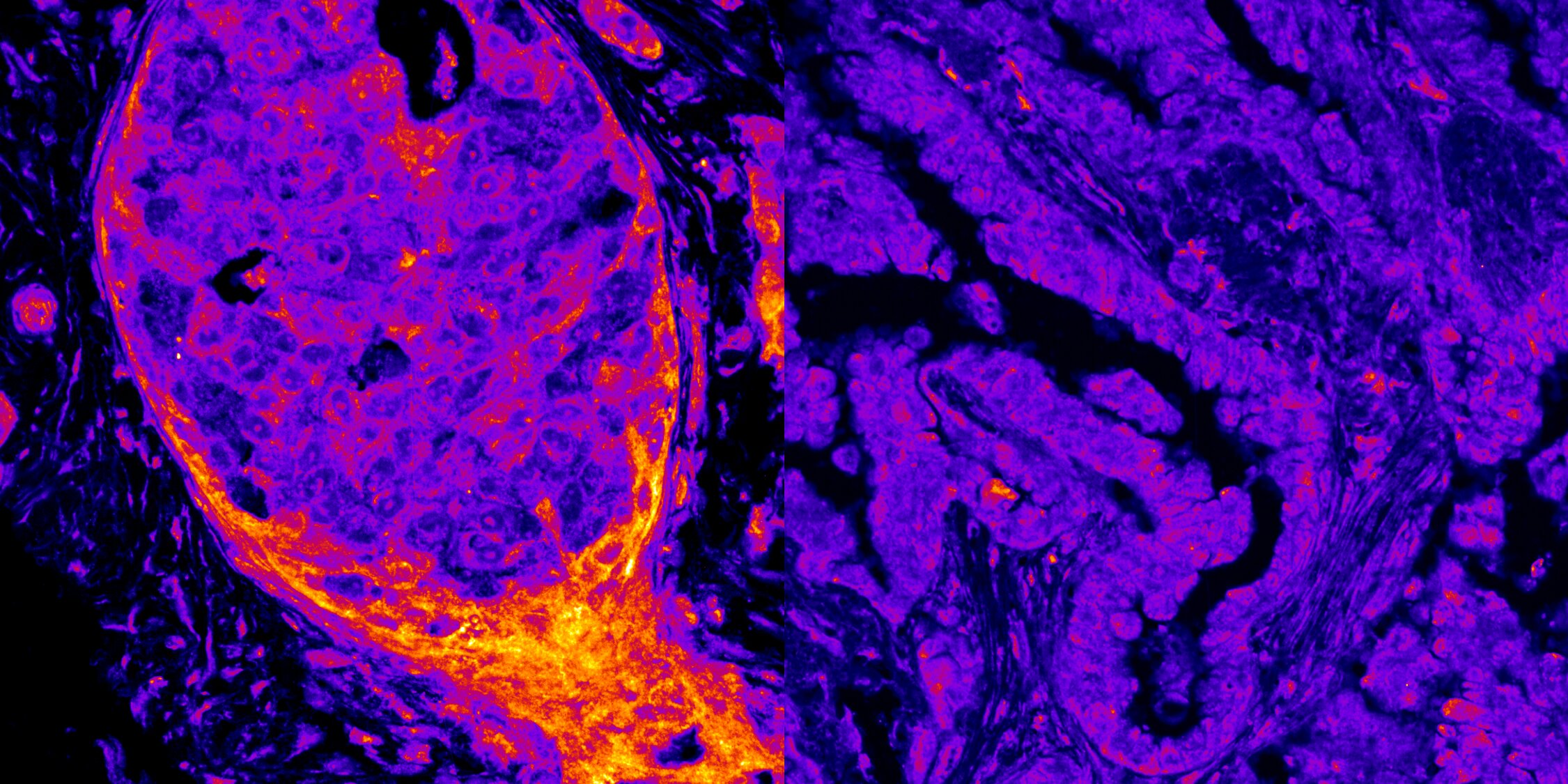 Les chercheurs découvrent que le cancer possède une empreinte métabolique nucléaire unique