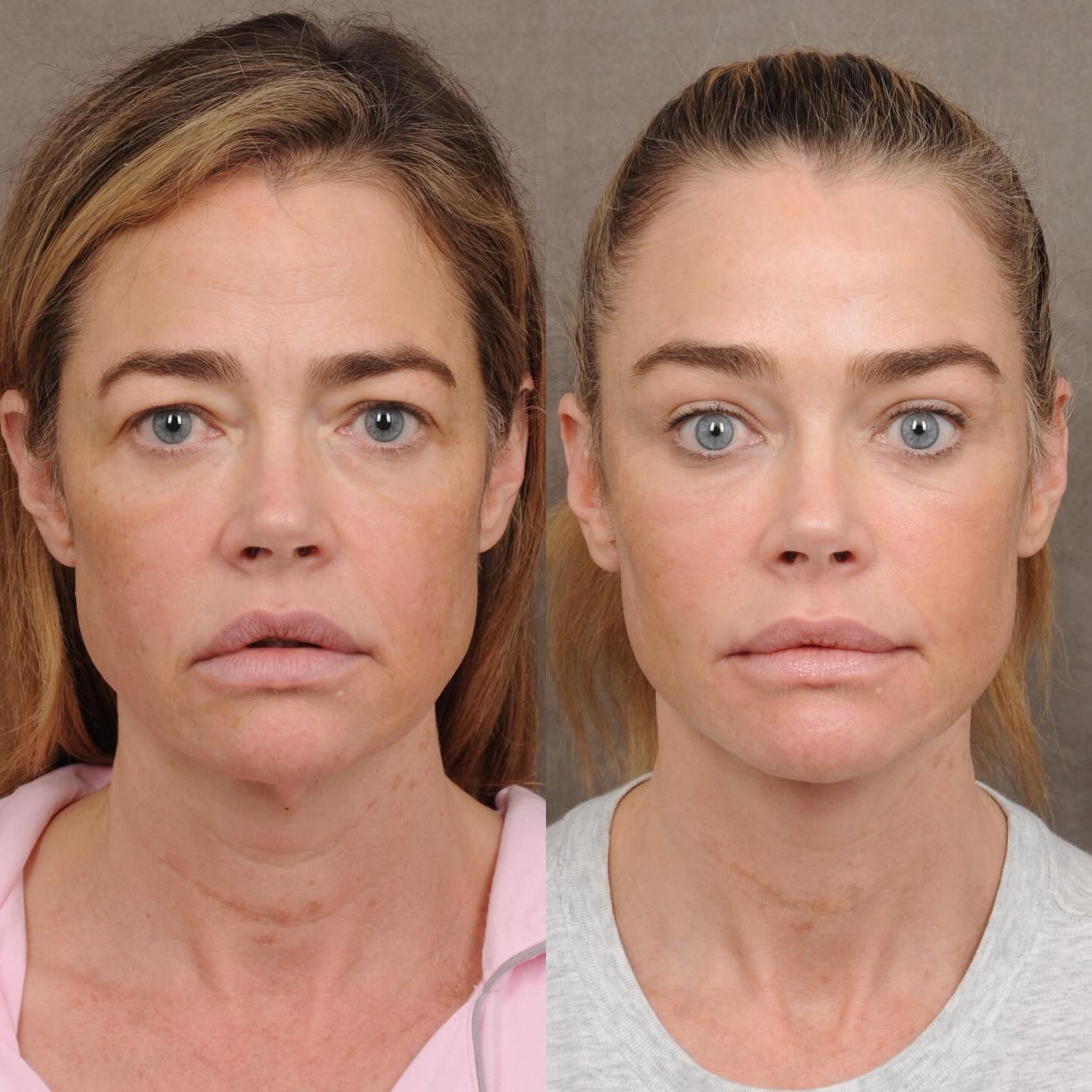 Denise Richards : la métamorphose choc après son opération du visage