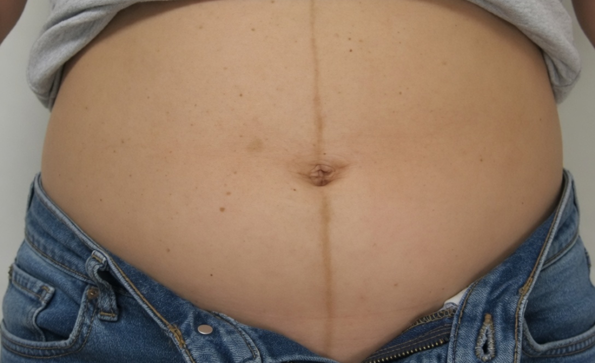 Savez-vous à quoi correspond la ligne verticale visible au milieu du ventre chez certaines femmes ?