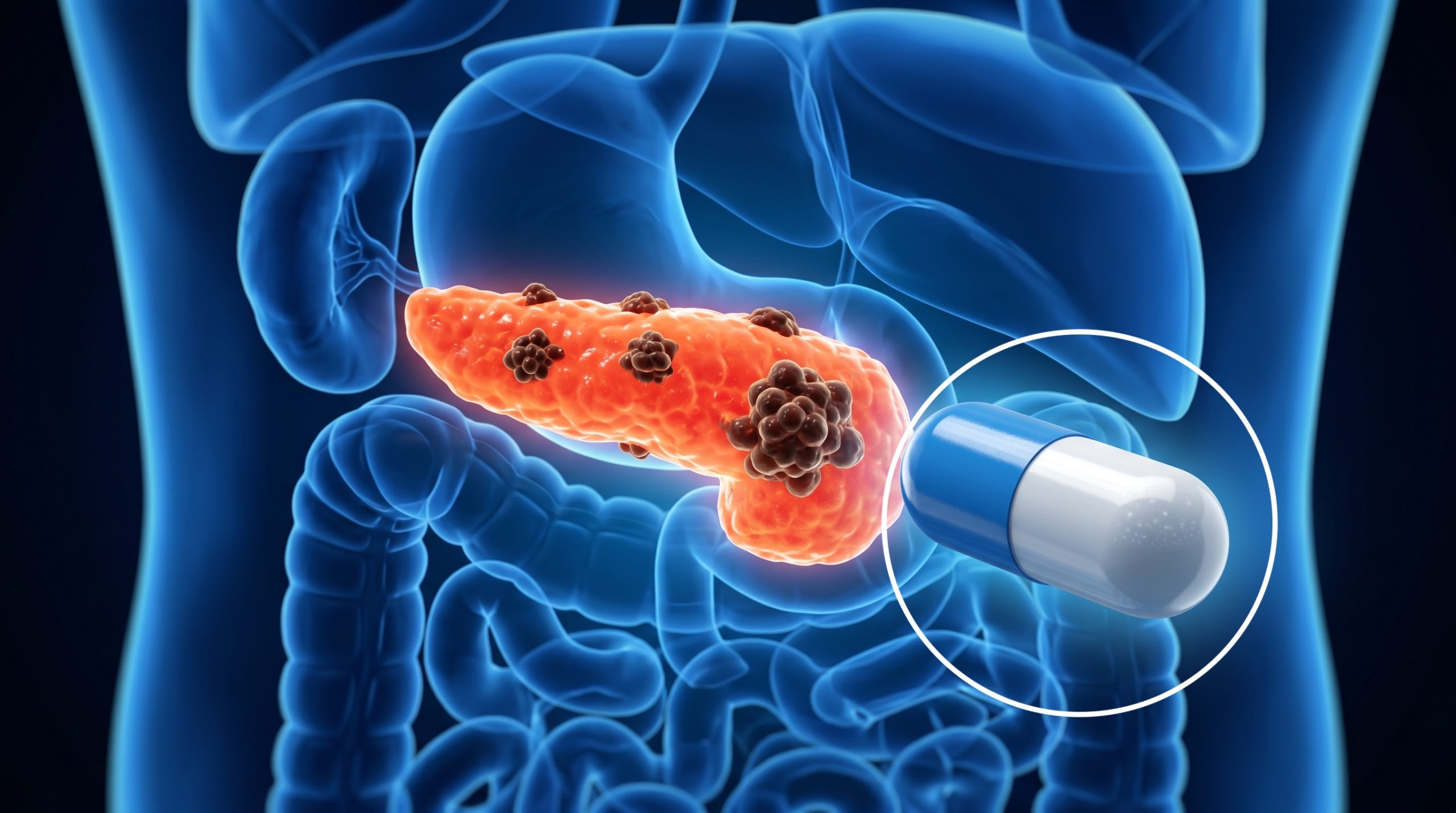 La pilule contre le cancer du pancréas qui a suscité l'enthousiasme des oncologues